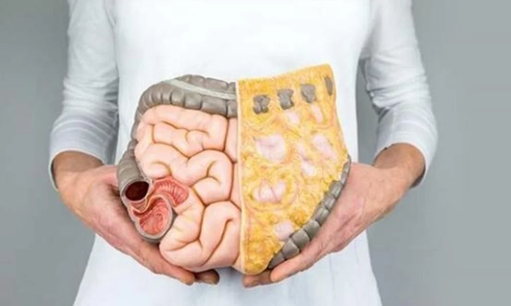 colon cancer 2