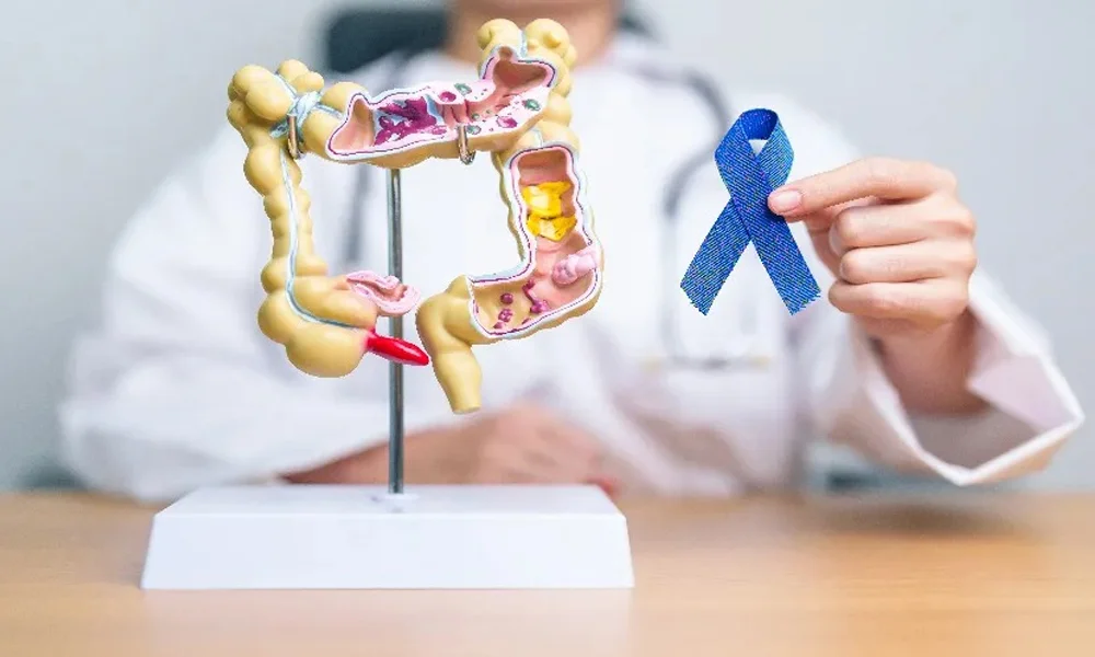 Colon cancer 3