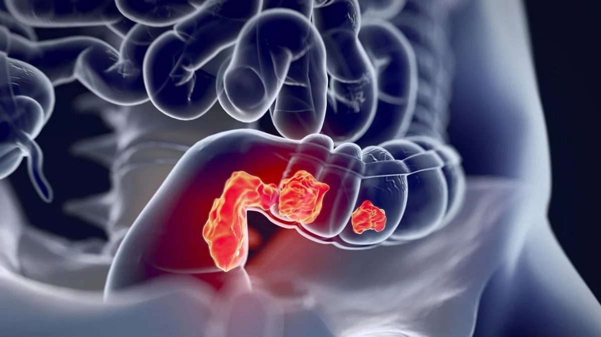 rectal cancer